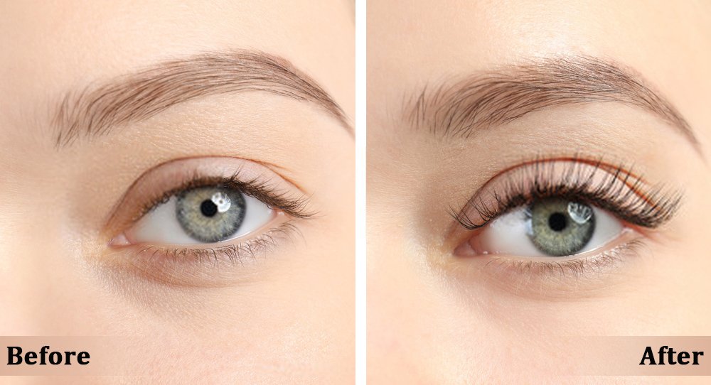 Before and After use of Careprost